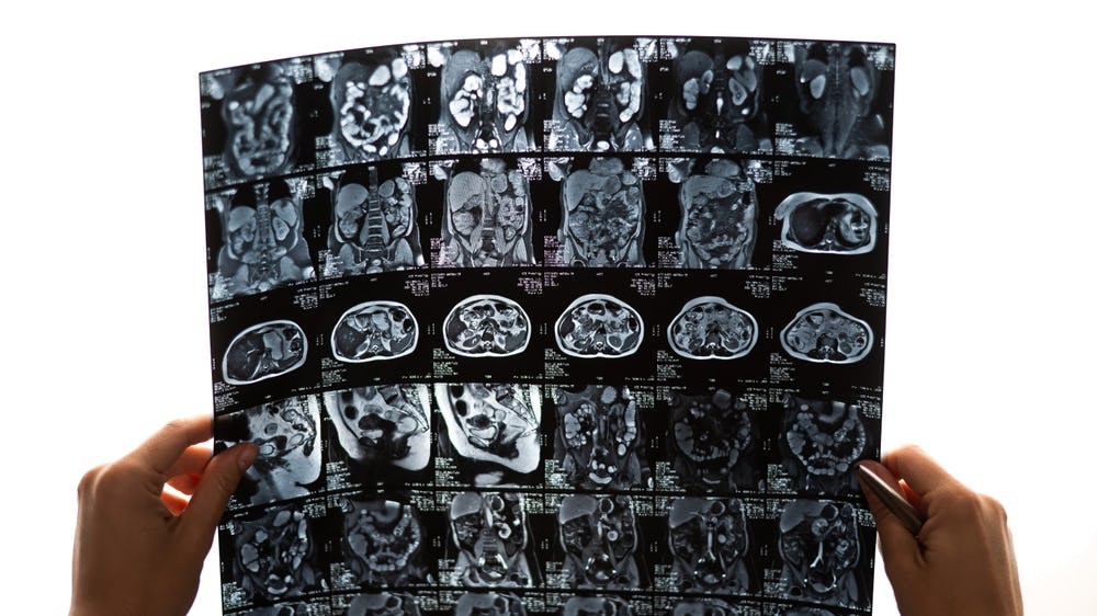 Placa vulnerável pela tomografia computadorizada: devo valorizar?