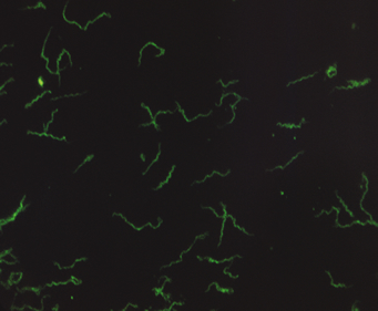 mononucleose infecciosa exames mononucleose infecciosa exames